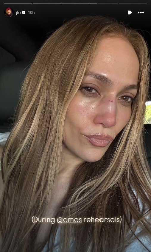 بالصور: إصابة جينيفر لوبيز في وجهها... ما السبب؟