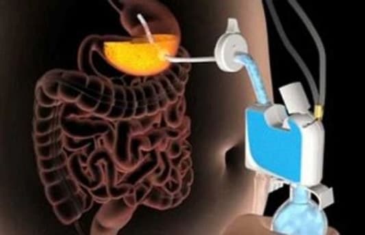 اختراع جديد لإنقاص الوزن: مضخة تسحب الطعام من المعدة