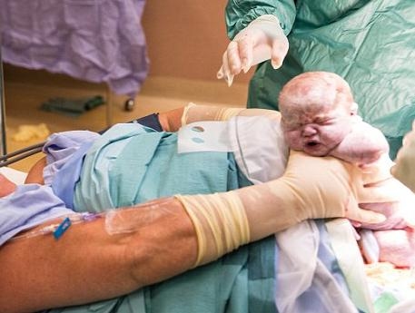 بالصور: وّلدت نفسها في عمليّة قيصرية!