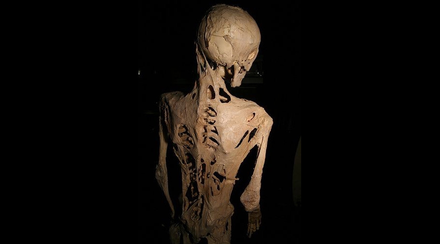 Study Shows Rare 'Stone Man' Disease Can be Cured