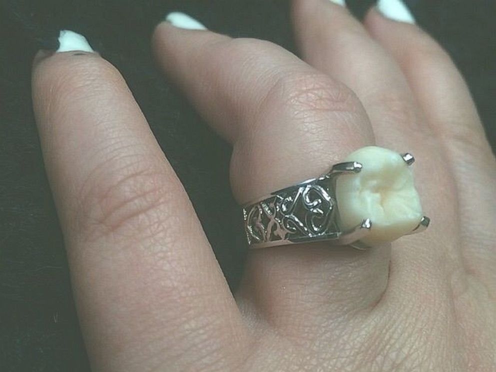 Man Proposes to Fiancee with 'Wisdom Tooth' Wedding Ring