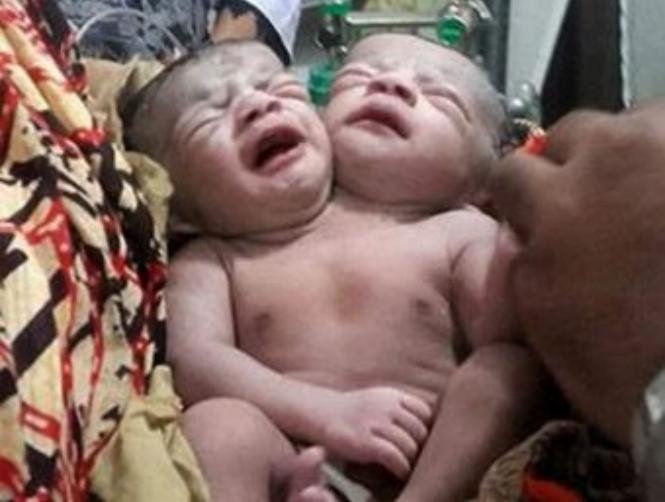 Baby Girl Born with Two Heads in Bangladesh