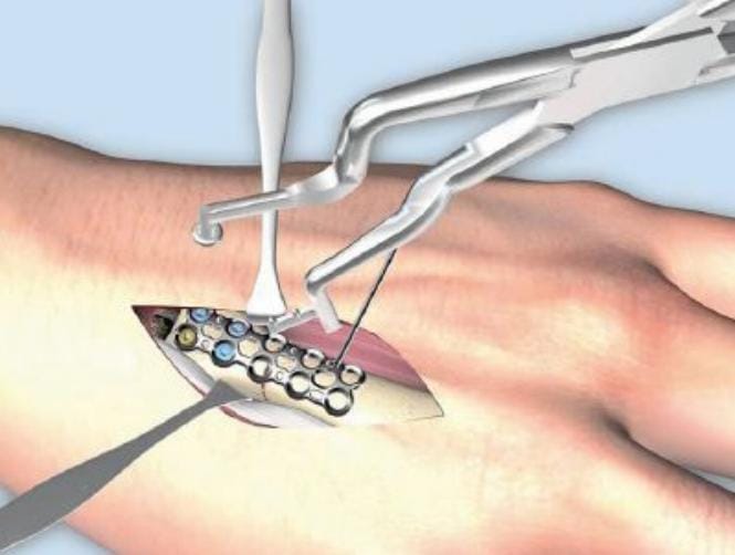 علاج للكسور.. بشريحة الكترونية