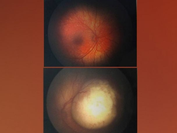 Camera Flash Detects Eye Cancer, Saves Baby's Life