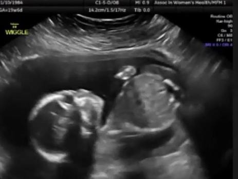 Video: Shocking Ultrasound Shows Baby Hitting Himself - MTV Lebanon