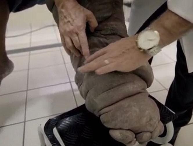 Mosquito Bite Turns Man into Elephant