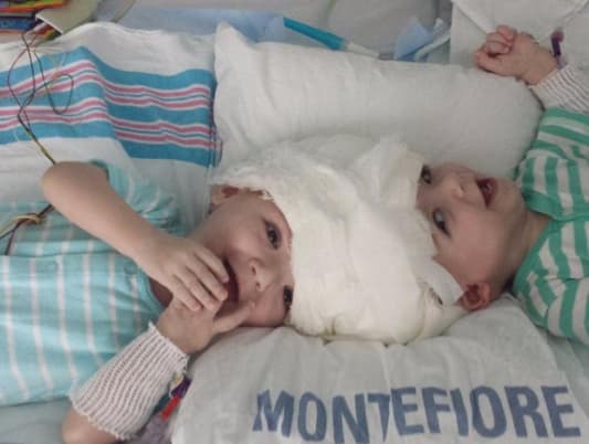 Conjoined Twins Successfully Separated in 16-Hour Surgery