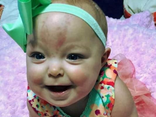 Baby Born with Adult-Sized Tongue Smiles After Life-Changing Surgery