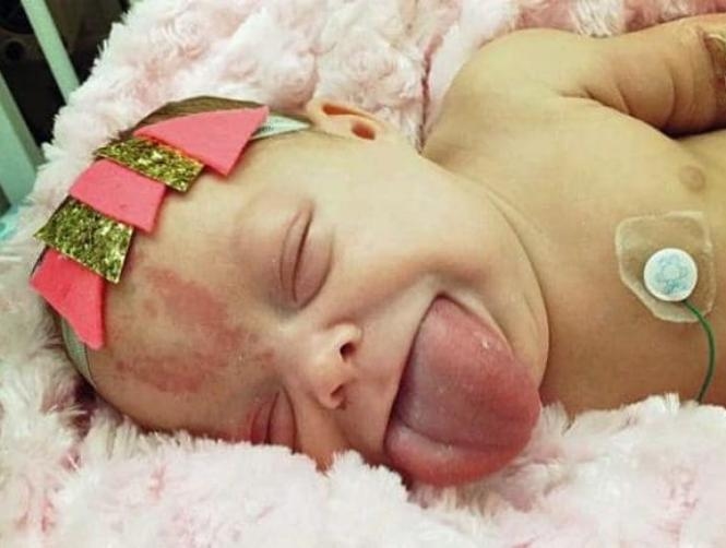 Baby Born with Adult-Sized Tongue Smiles After Life-Changing Surgery