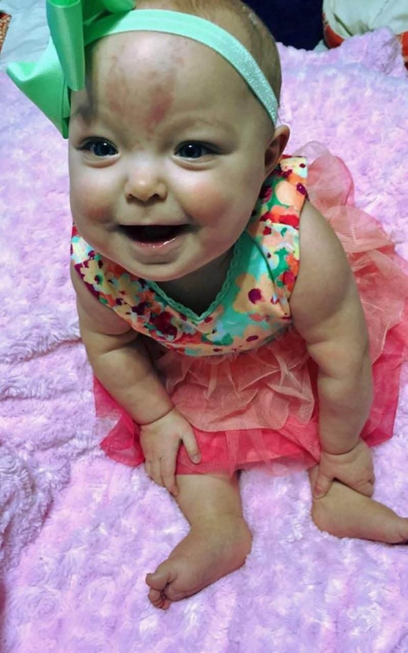 Baby Born with Adult-Sized Tongue Smiles After Life-Changing Surgery