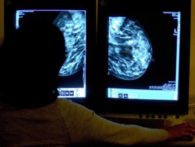 Joy as First Breast Cancer Drug Approved for Widespread Use in Ten Years