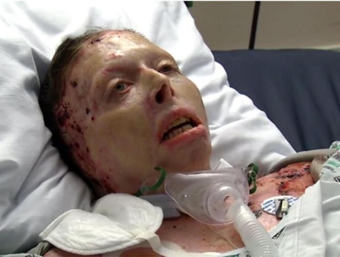 Woman Set on Fire by Boyfriend Warns Others About Domestic Abuse