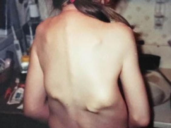 This Woman Is Growing a Second Skeleton - and It's Locking Her inside Her Own Body