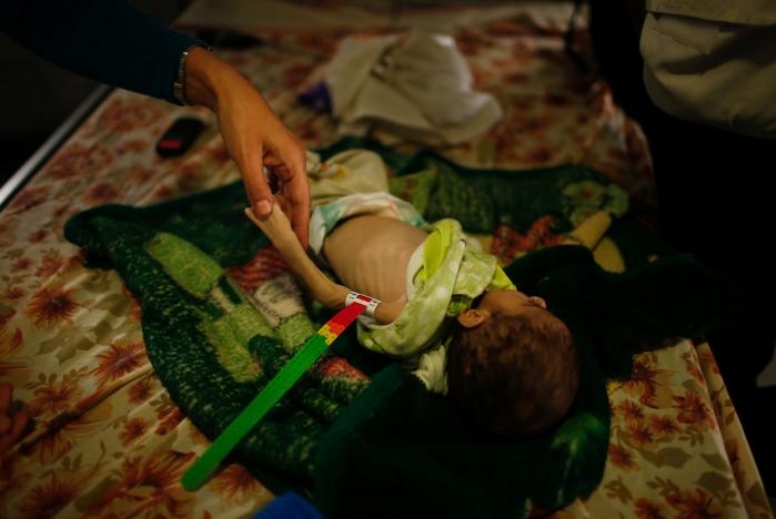 Photos: Babies Starve as War Grinds on in Mosul