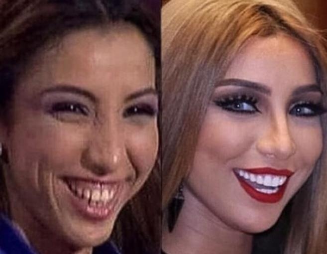 بالصور: دنيا بطمة قبل التجميل وبعده