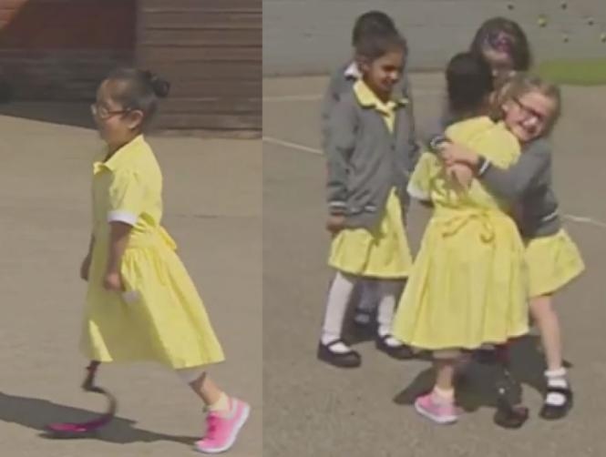 Watch: Child Shows Friends Her New Prosthetic Leg for First Time