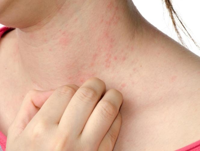 A Cure for Eczema Is on the Horizon