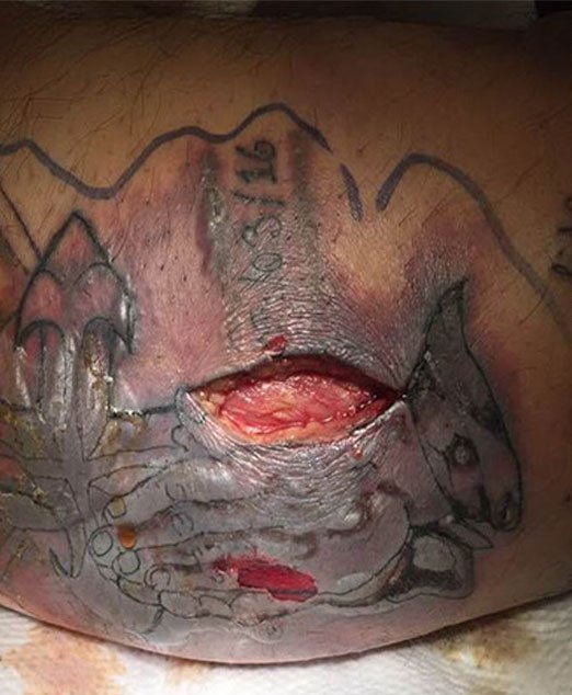 Photos: Danger of Swimming With New Tattoo Revealed After Man Dies From Infection