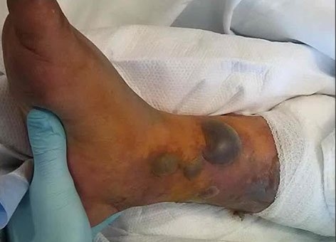 Photos: Danger of Swimming With New Tattoo Revealed After Man Dies From Infection