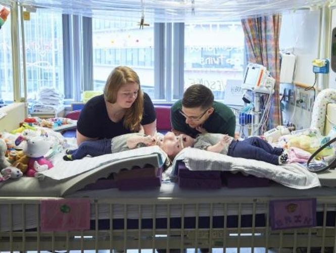 Twin Girls Conjoined at the Head Successfully Separated by 30-Strong Surgical Team
