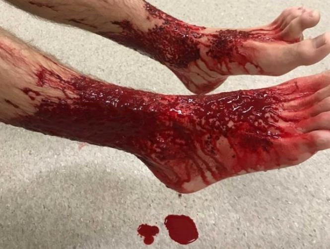 Photos: Teenage Boy's Legs Eaten by Tiny Sea Creatures