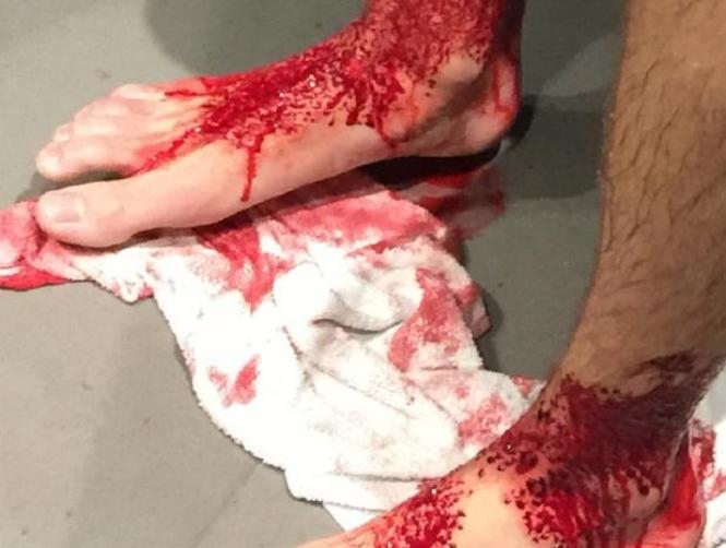 Photos: Teenage Boy's Legs Eaten by Tiny Sea Creatures
