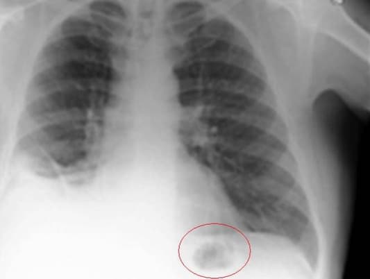 Man Thought to Have Lung Cancer Discovers It Was Toy He Swallowed as Child
