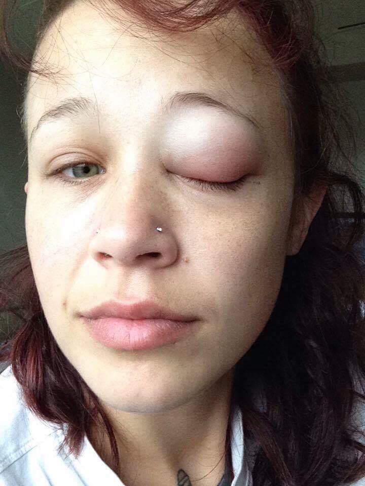 Photos: Eye Tattoo Leaves Model Partially Blind