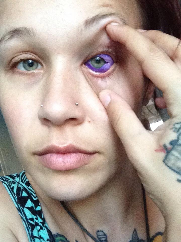 Photos: Eye Tattoo Leaves Model Partially Blind