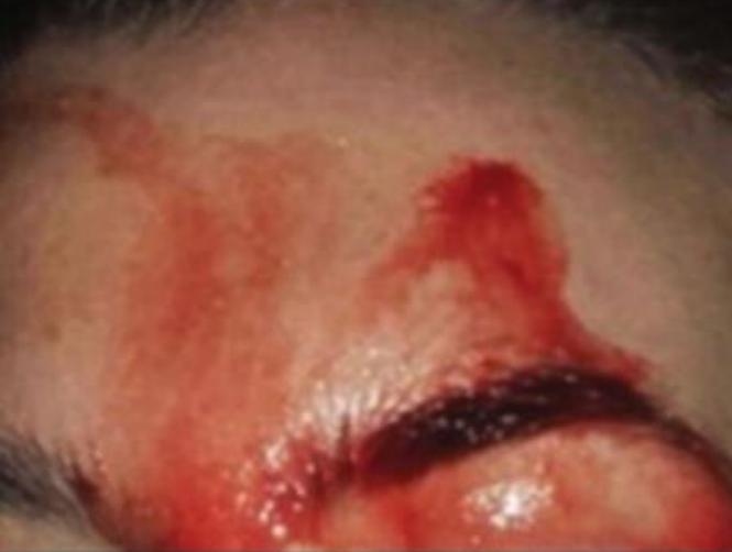 Photo: Woman Who Sweats Blood From Face and Hands Baffles Doctors