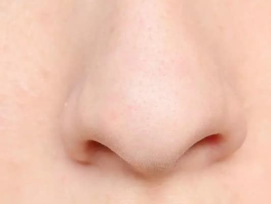 Those Blackheads on Your Nose Are Probably Something Else Altogether