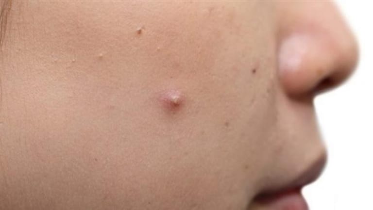 هكذا يُمكن التخلّص من الرؤوس البيضاء