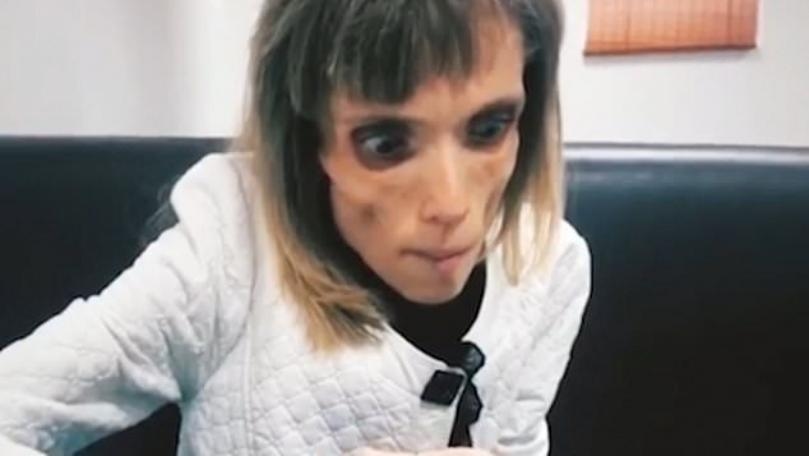 Doctor Tells Anorexic Woman She Could Play a Living Corpse in a Horror Movie