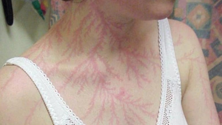 This Is What Happens to Your Body If You're Struck by Lightning