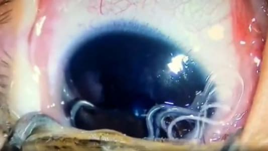 11 Worms Pulled Out of Baby's Eyeball After They Were Caught From Pet
