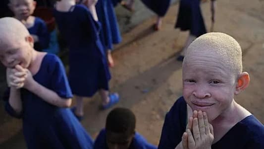 Malawi offers $7,000 reward to stop albino killings