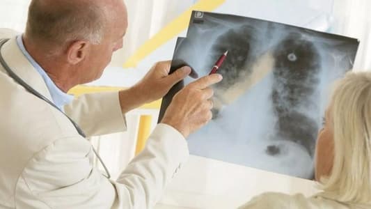 "غوغل" يتفوّق على الأطباء بكشف سرطان الرئة