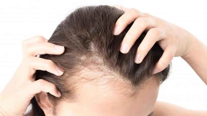 Divorce, Heavy Drinking, Smoking Linked to Hair Loss