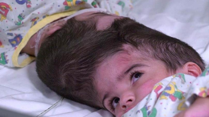 UK doctors reveal separation of twins joined at the head