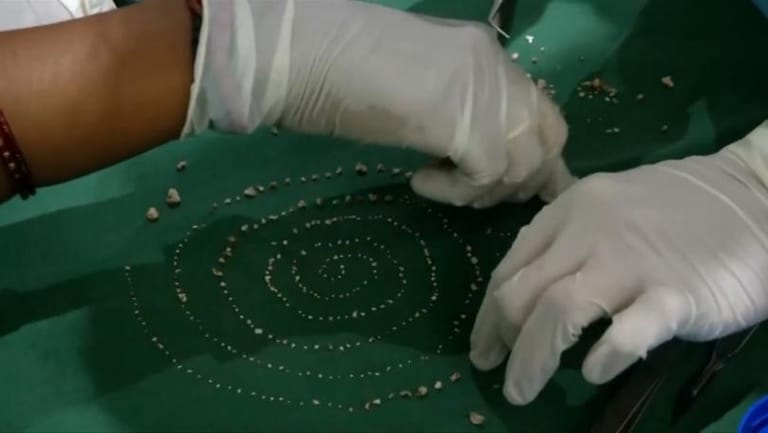 Child Has 526 ‘Teeth’ Removed From Mouth