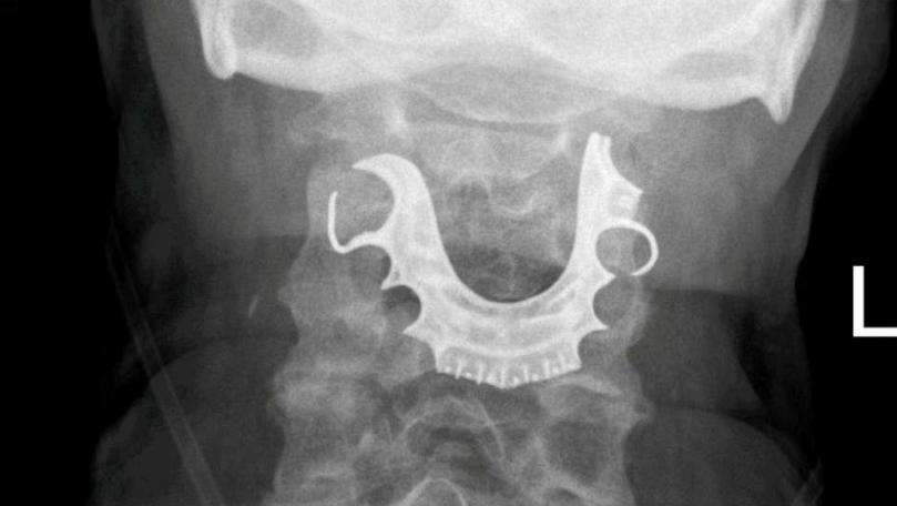 False Teeth Found Lodged in Man’s Voicebox After He Coughed Up Blood