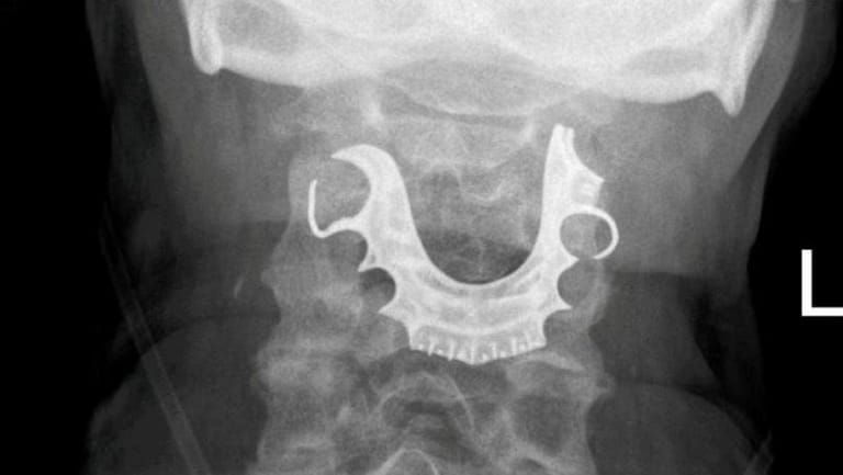 False Teeth Found Lodged in Man’s Voicebox After He Coughed Up Blood