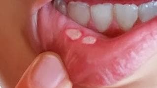 التغيّرات الهرمونية تسبّب ظهور تقرّحات الفم