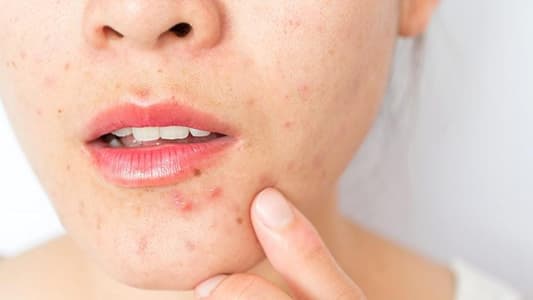 Foods to Avoid During an Acne Breakout, According to Dermatologists