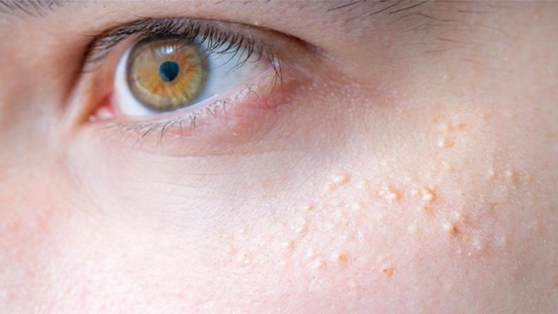 How to Get Rid of Milia Under Your Eyes