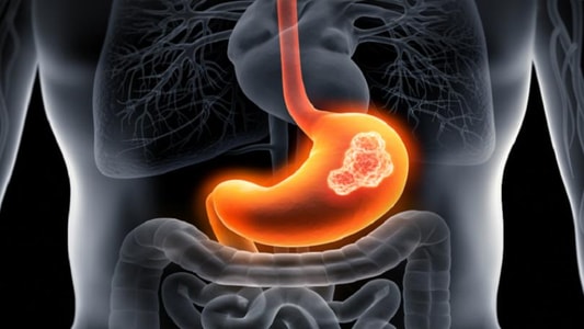 Warning Signs of Stomach Cancer: What to Look Out For