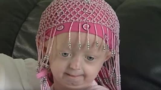 شيخوخة مبكرة لدى طفلة أوكرانية تؤدي لوفاتها