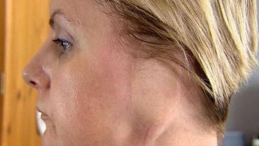 سرطان الجلد أفقد امرأة بريطانيّة أذنها