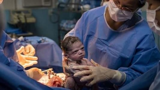 صورة لطفلة حديثة الولادة عابسة في غرفة العمليات 