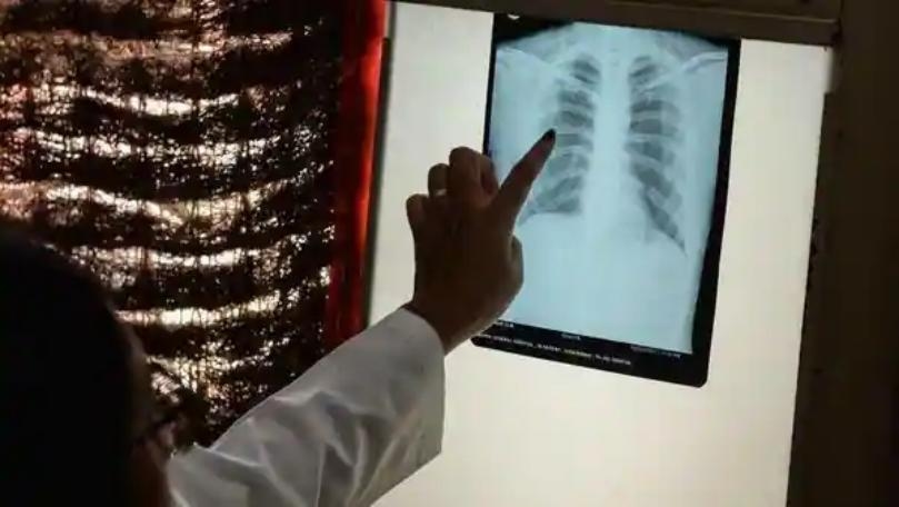 Deaths From Tuberculosis Are on the Rise for First Time in a Decade, WHO Says